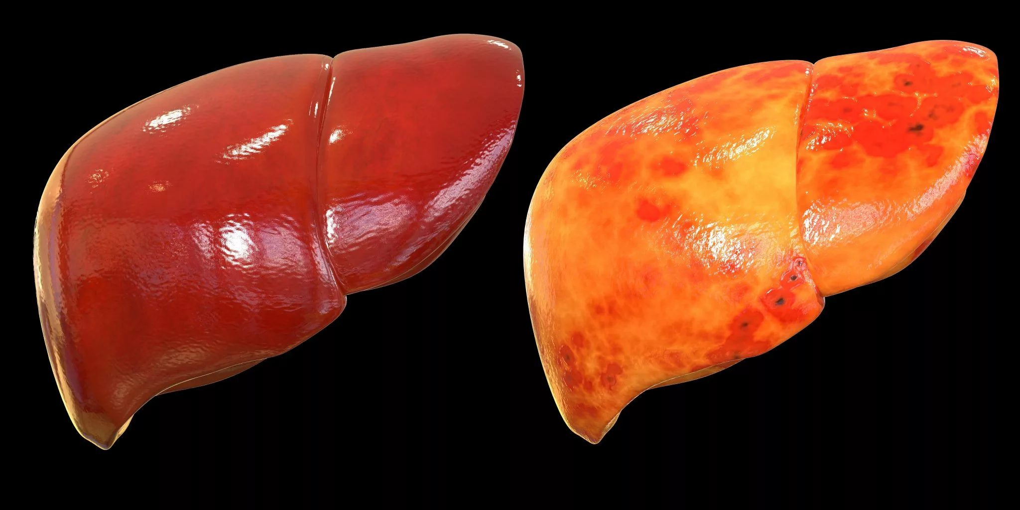 How to Transition from a Fatty Liver to a Healthy Liver with Ketosis