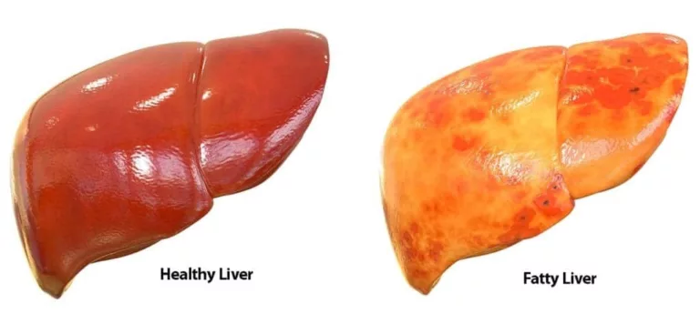 from Fatty Liver to a Healthy Liver