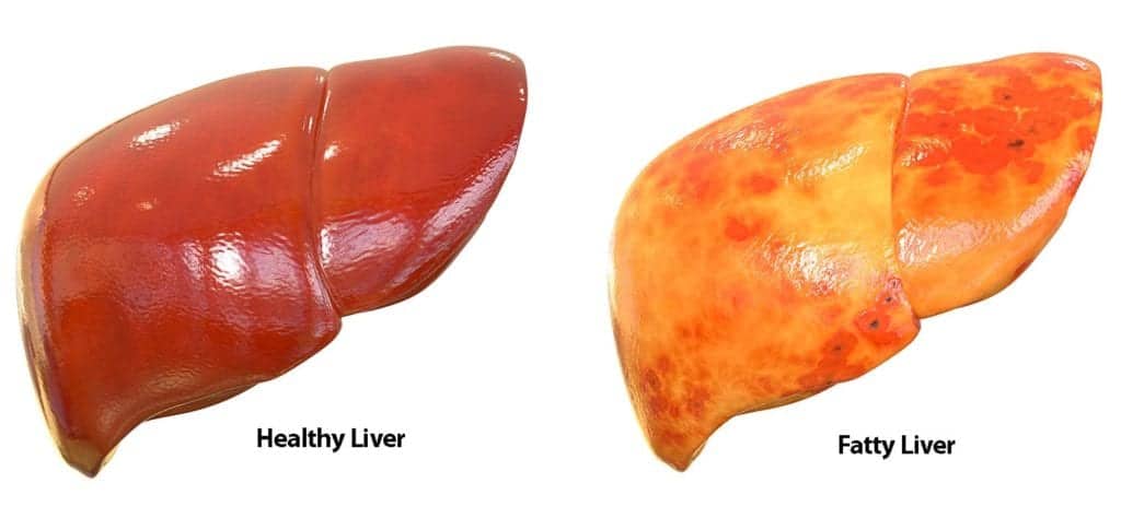 from Fatty Liver to a Healthy Liver